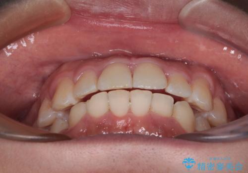 前方に捻れた前歯を治したい インビザライン矯正治療の治療中