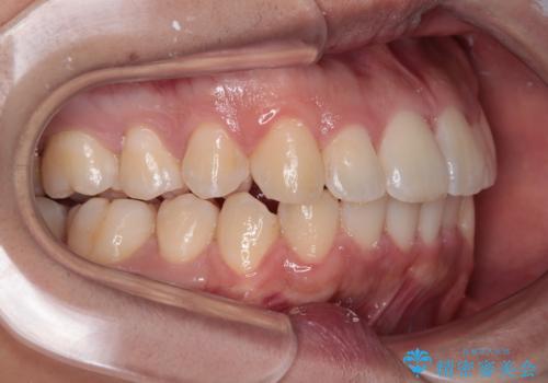 前方に捻れた前歯を治したい インビザライン矯正治療の治療中