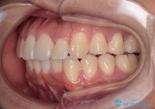 前方に捻れた前歯を治したい インビザライン矯正治療の治療中