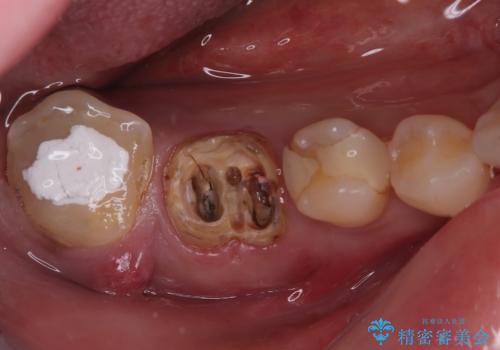 酷く歯茎が腫れた奥歯　抜歯してブリッジ治療への治療前