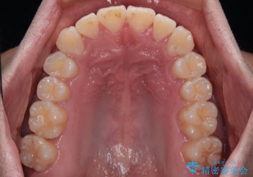 前方に捻れた前歯を治したい インビザライン矯正治療の治療中