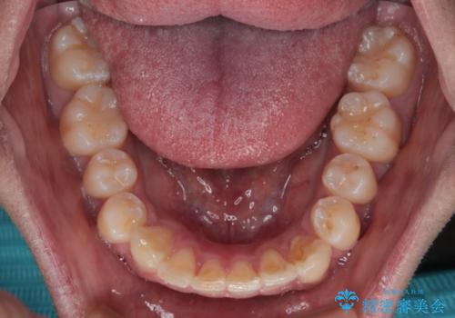 前方に捻れた前歯を治したい インビザライン矯正治療の治療中