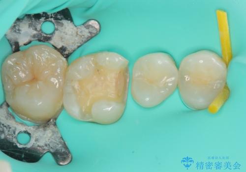 上の銀歯をやり替えたい セラミックインレー修復の治療中