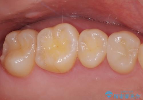 精度の高い治療をしたい。セラミックインレー修復