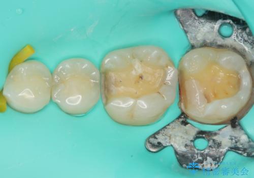 銀歯がとれたのでついでに他もやり替えたい セラミックインレー修復・セラミックアンレー修復の治療中