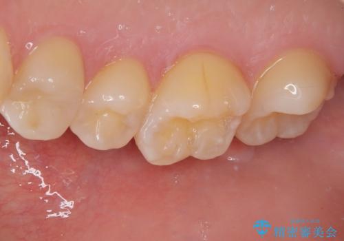 精度の高い治療をしたい。セラミックインレー修復の治療後