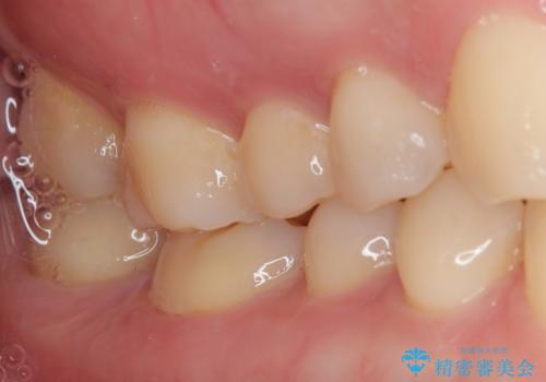 精度の高い治療をしたい。セラミックインレー修復の治療後