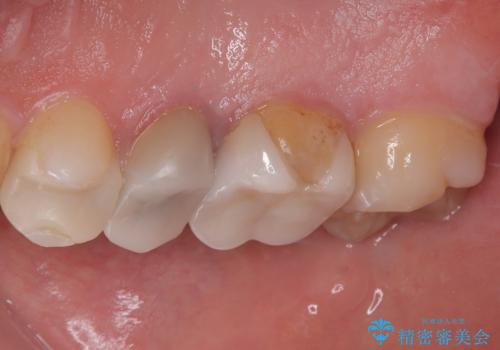 セラミックが欠けた オールセラミッククラウンの治療前