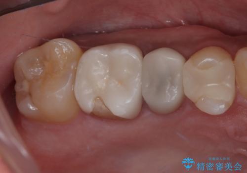 セラミックが欠けた オールセラミッククラウンの症例 治療前