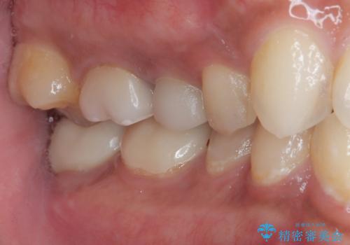 セラミックが欠けた オールセラミッククラウンの治療前