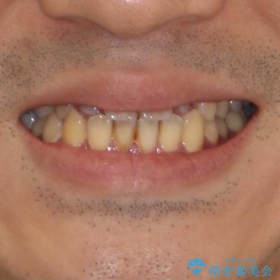 内側に引っ込んだ歯を治したい インビザラインの矯正治療の治療前(顔貌)