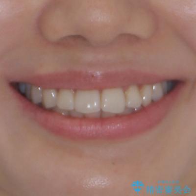 上下前歯のデコボコ ワイヤー装置で楽ちん矯正治療の治療前(顔貌)