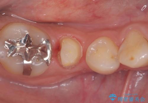 虫歯治療|歯を長持ちさせるための治療|セラミッククラウン|審美回復|精密根管治療の治療中