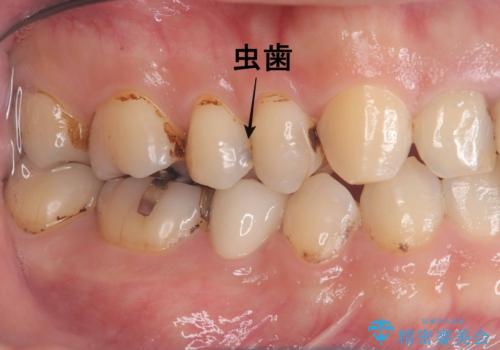 虫歯治療|歯を長持ちさせるための治療|セラッミクインレー|審美回復の治療前