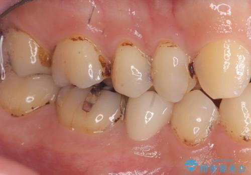 虫歯治療|歯を長持ちさせるための治療|セラミッククラウン|審美回復|精密根管治療の治療後