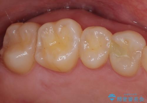 精度の高い治療をしたい。セラミックインレー修復の治療前