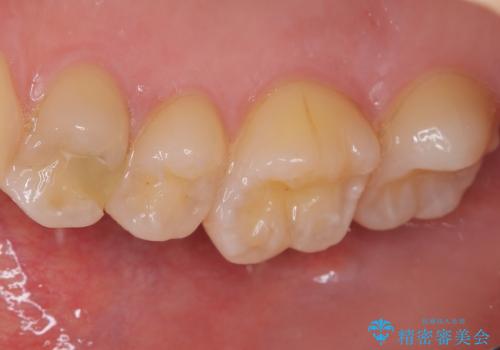 精度の高い治療をしたい。セラミックインレー修復の治療前