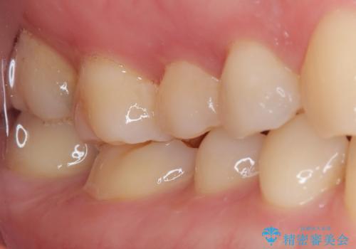 精度の高い治療をしたい。セラミックインレー修復の治療前