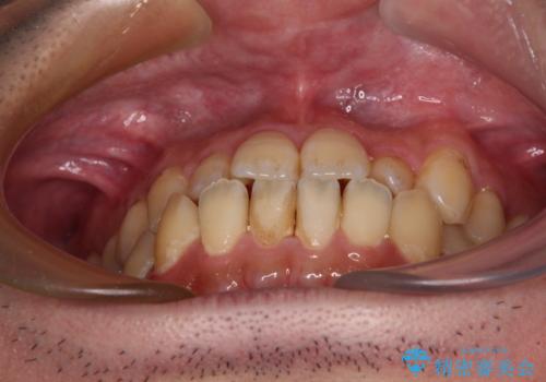 内側に引っ込んだ歯を治したい インビザラインの矯正治療の治療前