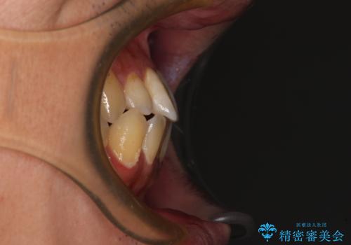 内側に引っ込んだ歯を治したい インビザラインの矯正治療の治療前