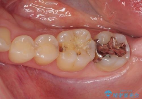 銀歯がとれたのでついでに他もやり替えたい セラミックインレー修復・セラミックアンレー修復の治療前