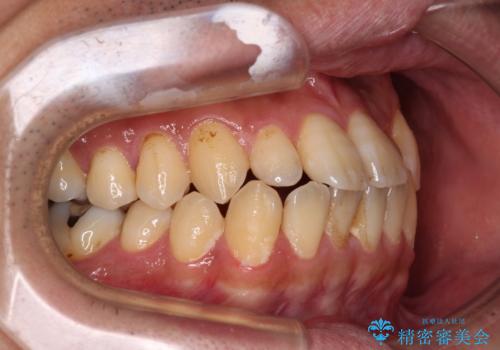 内側に引っ込んだ歯を治したい インビザラインの矯正治療の治療前