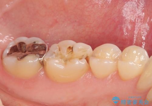 銀歯がとれたのでついでに他もやり替えたい セラミックインレー修復・セラミックアンレー修復の治療前