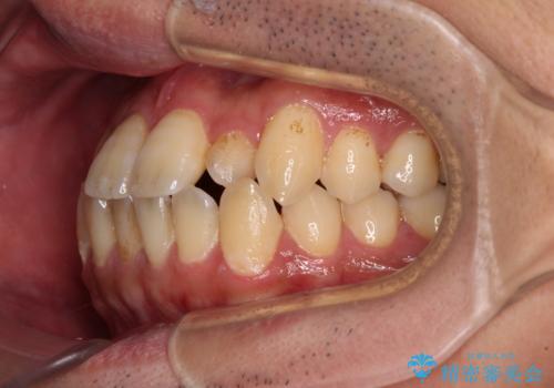 内側に引っ込んだ歯を治したい インビザラインの矯正治療の治療前