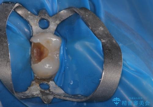 精度の高い治療をしたい。セラミックインレー修復の治療中