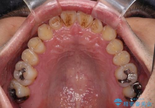 内側に引っ込んだ歯を治したい インビザラインの矯正治療の治療前