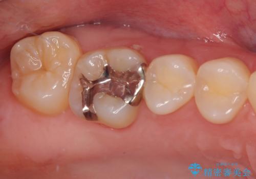 上の銀歯をやり替えたい セラミックインレー修復の治療前