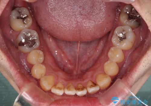 内側に引っ込んだ歯を治したい インビザラインの矯正治療の治療前
