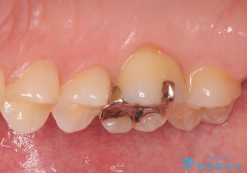 上の銀歯をやり替えたい セラミックインレー修復の治療前