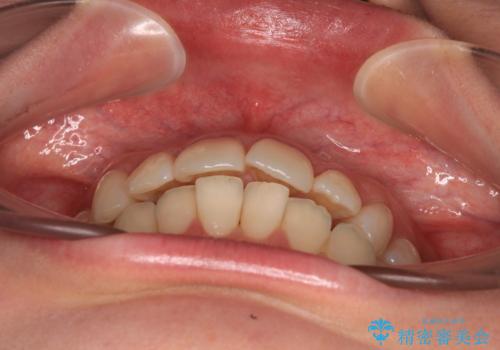 上下前歯のデコボコ ワイヤー装置で楽ちん矯正治療の治療前