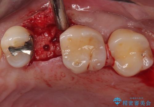 手術が怖くて抜いたままの奥歯に歯を 1DAYインプラント治療の治療前