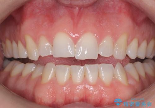 輝きのある笑顔への治療前