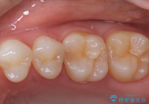 セラミックインレー 虫歯の治療の治療前