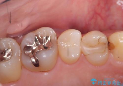 虫歯治療|歯を長持ちさせるための治療|セラッミクインレー|審美回復の症例 治療後