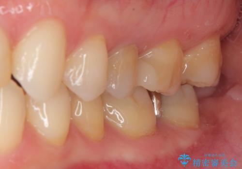 銀歯がとれたのでついでに他もやり替えたい セラミックインレー修復・セラミックアンレー修復の治療前