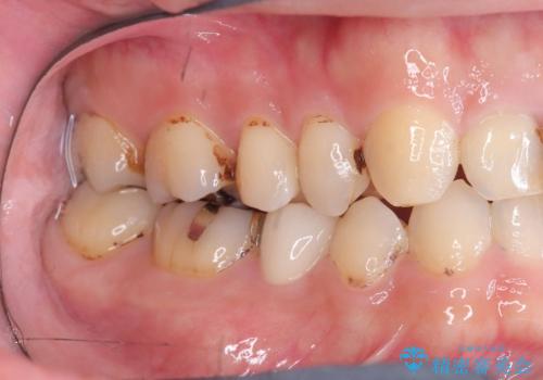 虫歯治療|歯を長持ちさせるための治療|セラッミクインレー|審美回復の治療後