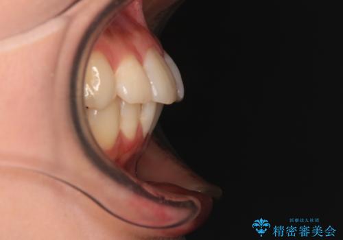 上下前歯のデコボコ ワイヤー装置で楽ちん矯正治療の治療前