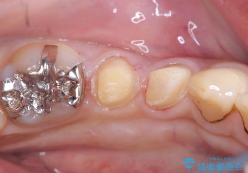 CRの劣化による虫歯|虫歯治療|セラミッククラウン|審美回復|神経を残す治療の治療中