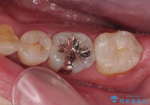 詰め物が欠けて虫歯になってる気がする セラミックインレー修復の治療後