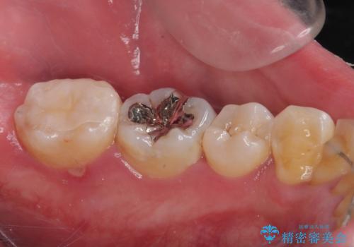 詰め物が欠けて虫歯になってる気がする セラミックインレー修復の治療後
