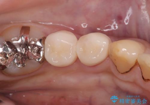 CRの劣化による虫歯|虫歯治療|セラミッククラウン|審美回復|神経を残す治療の症例 治療後