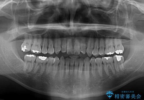 内側に引っ込んだ歯を治したい インビザラインの矯正治療の治療前