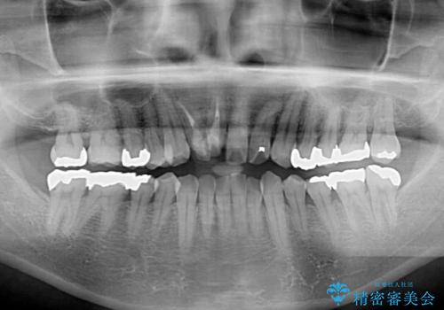 隠れている前歯 インビザライン矯正治療と前歯のセラミック治療の治療前