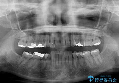 ディープバイトと前歯のデコボコ インビザラインによる矯正治療の治療前