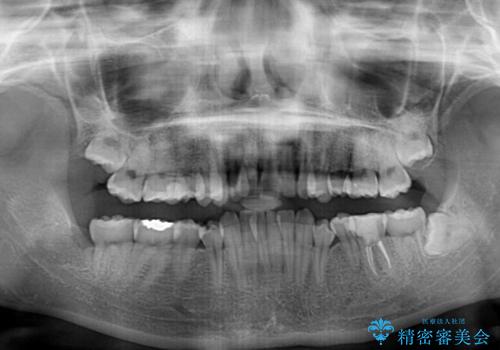 【モニター】デコボコ前歯を治したい ワイヤー装置での抜歯矯正治療の治療前