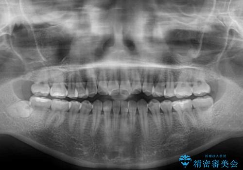 上下非接触の前歯 口元の突出感を改善する抜歯矯正の治療前